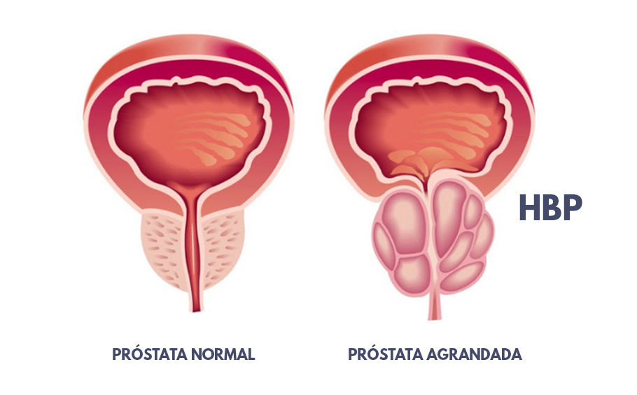 Avicenna a prosztatitisből Prostatitis kenőcs felülvizsgálata