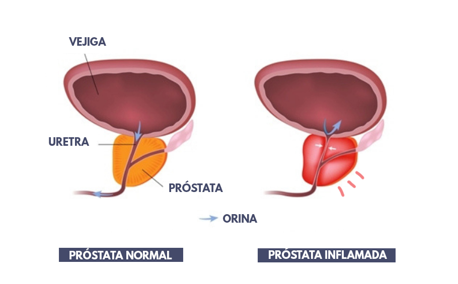 Jó recept a prosztatagyulladásra, Prosztatagyulladás (prostatitis)